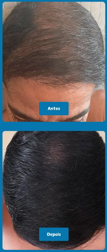 Tratamento Regenera